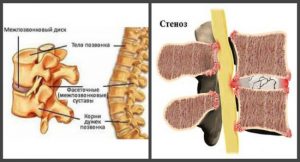 stenoz-300x162.jpg